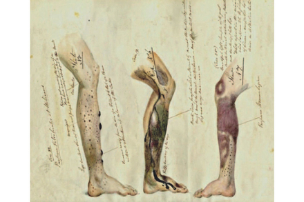 Les signes cutanés du scorbut. Par le chirurgien de marine Henry W. Mahon (1841), The National Archives (UK).(B)